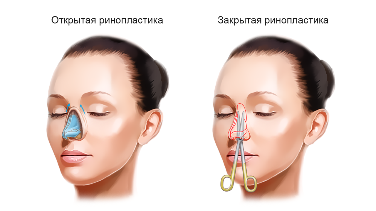 Ринопластика